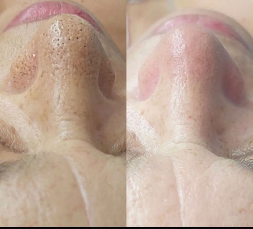 Limpeza de Pele FM
